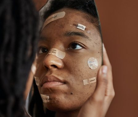 How to treat morpheus8 acne scars