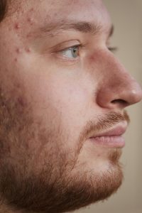 Can hormone therapy help with acne?