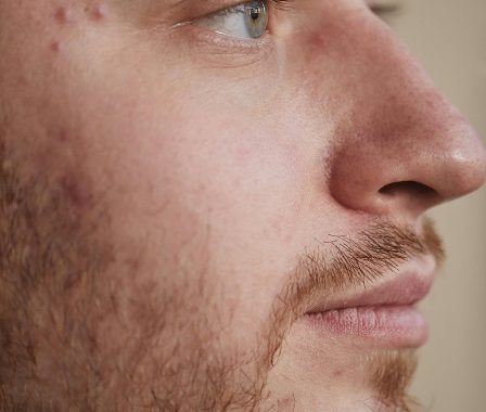 Can hormone therapy help with acne?